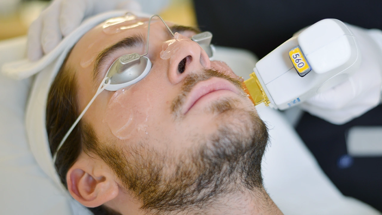 Homme en train de faire une séance de laser pigmentaire