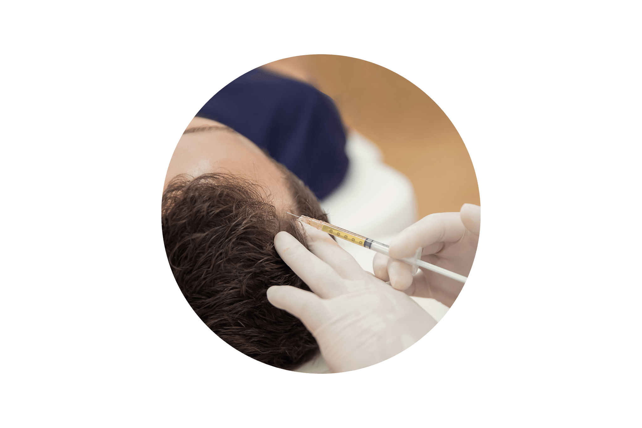 Mésothérapie capillaire sur un homme