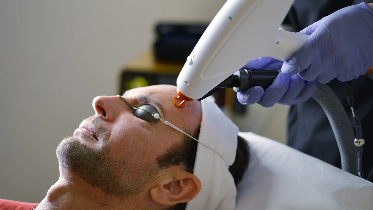 Homme bénéficiant d'une séance de laser fractionné