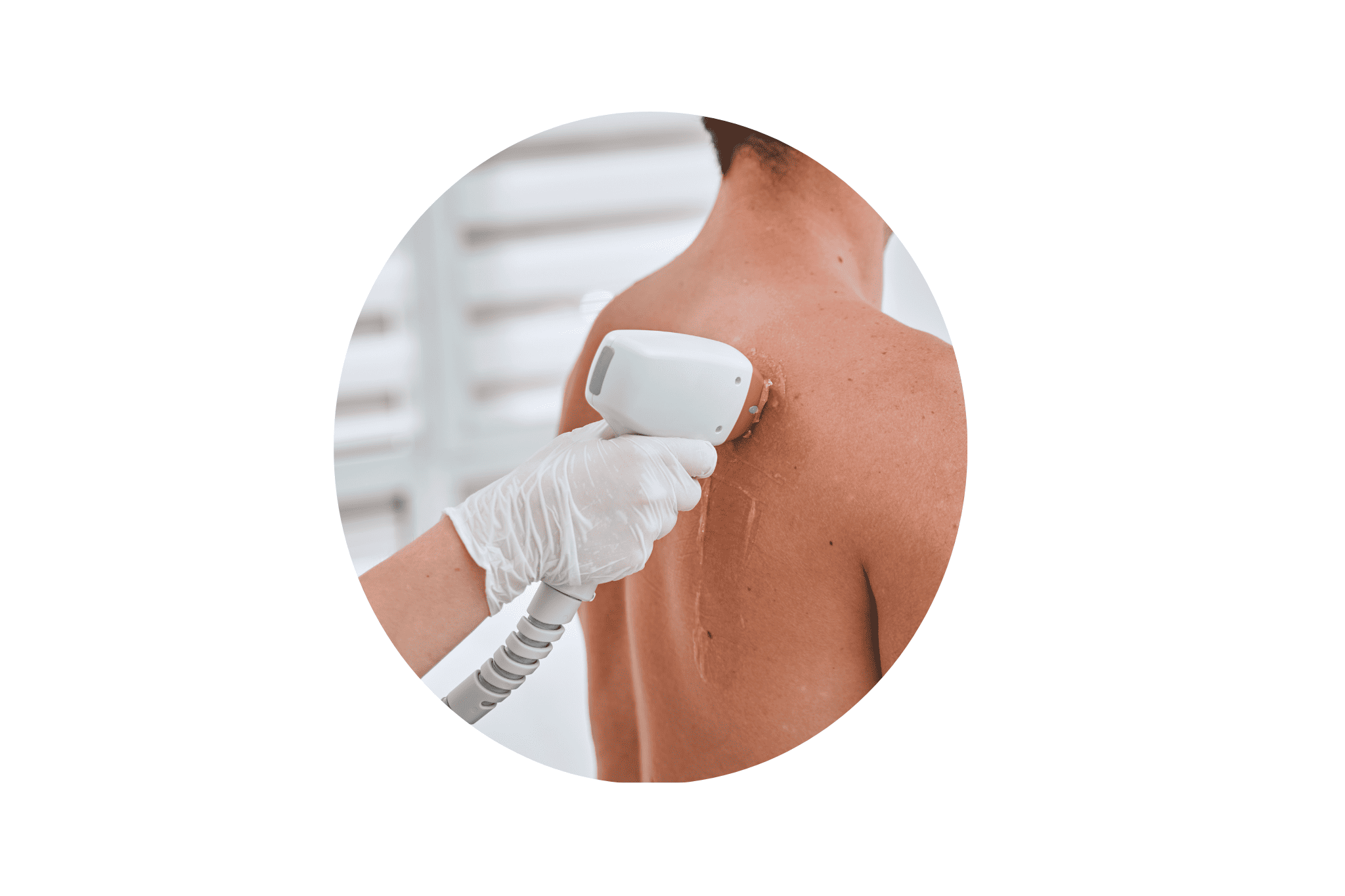 Monsieur qui se fait épiler le dos au laser