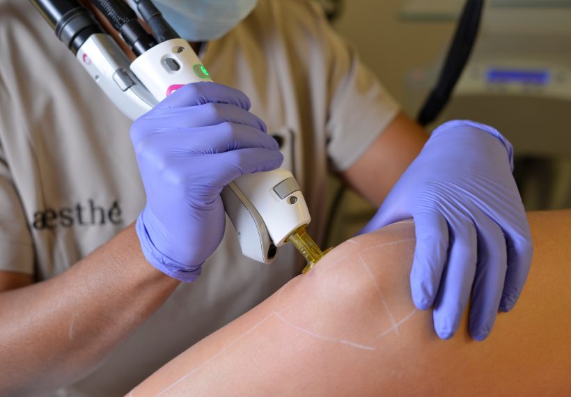 séance d'épilation laser