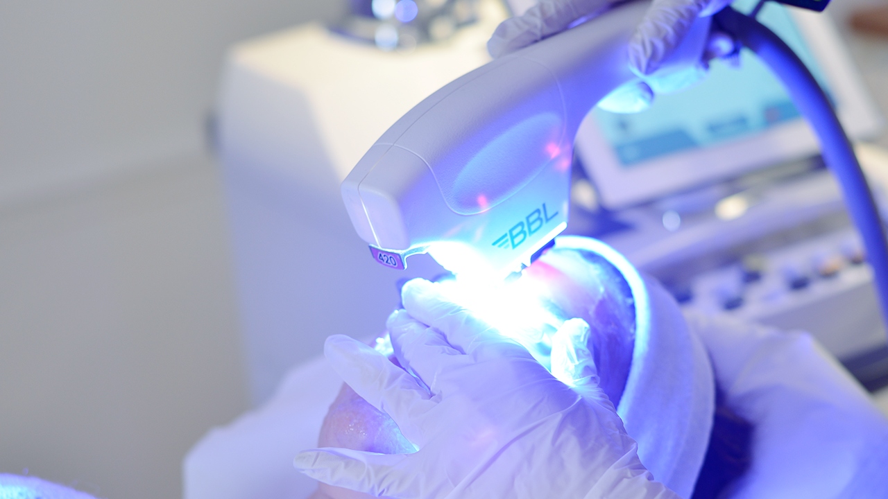 séance de laser bbl