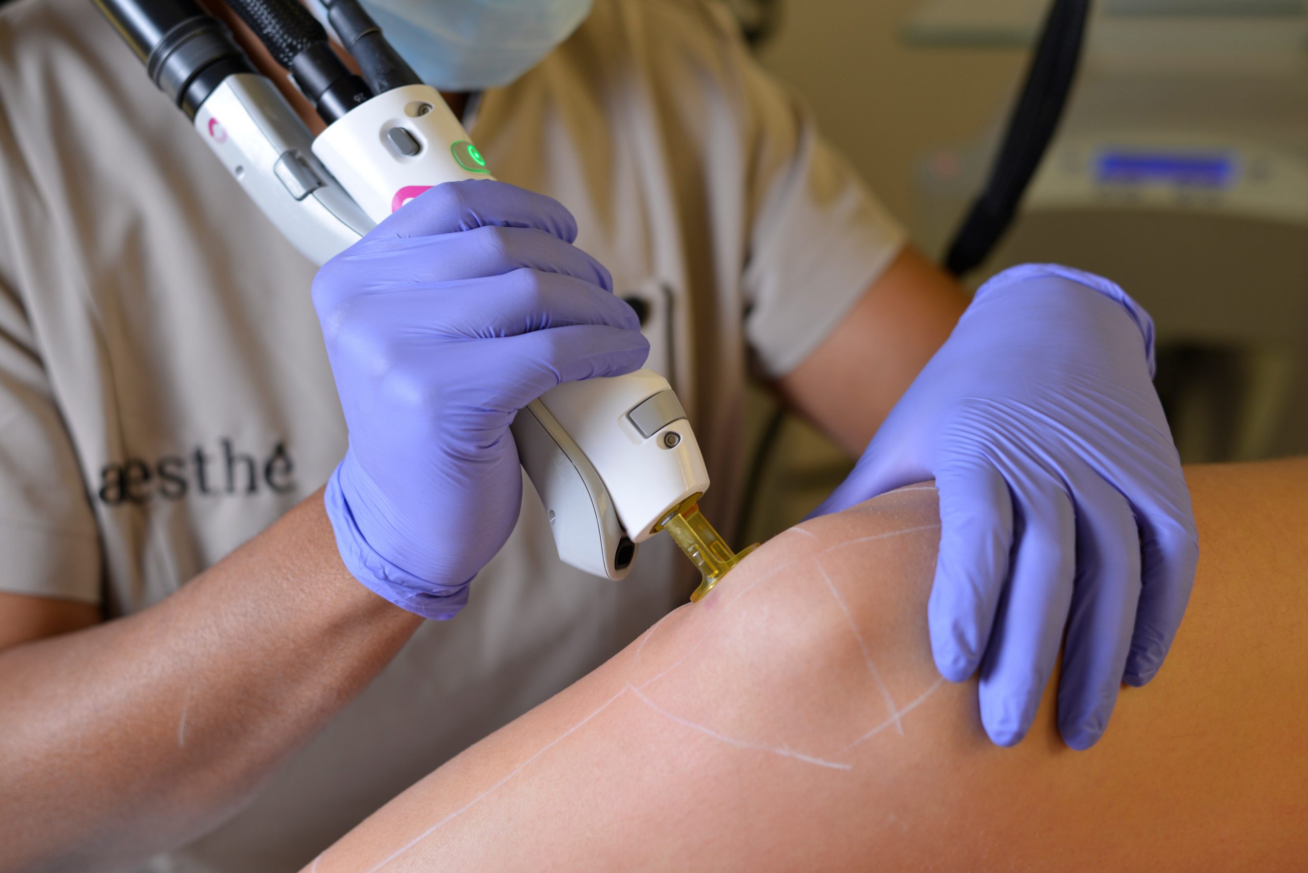 séance d'épilation laser