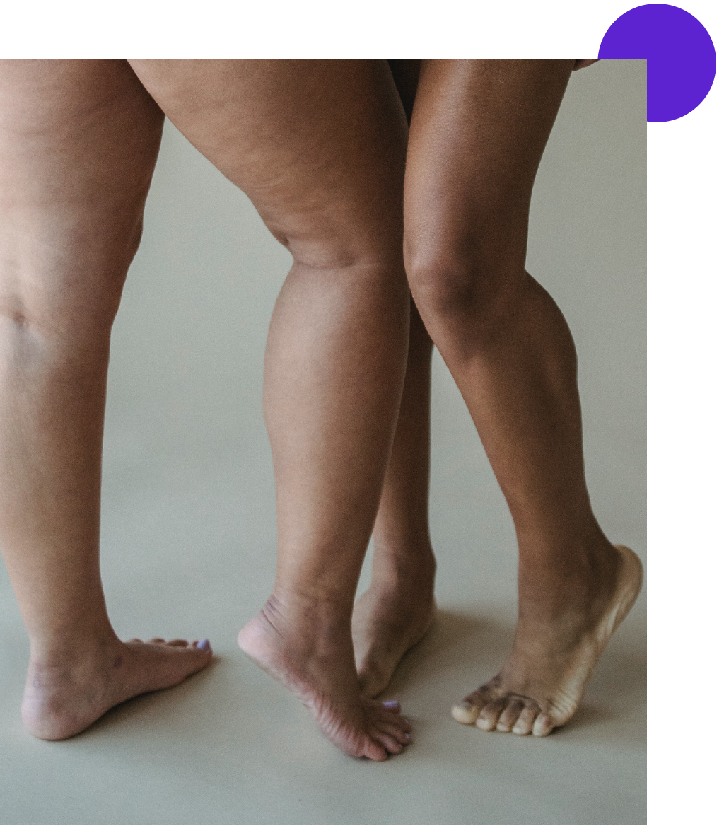 zoom sur cuisses avec cellulite