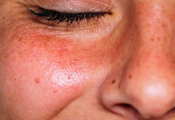 peau hydratée grâce au soin hydrafacial