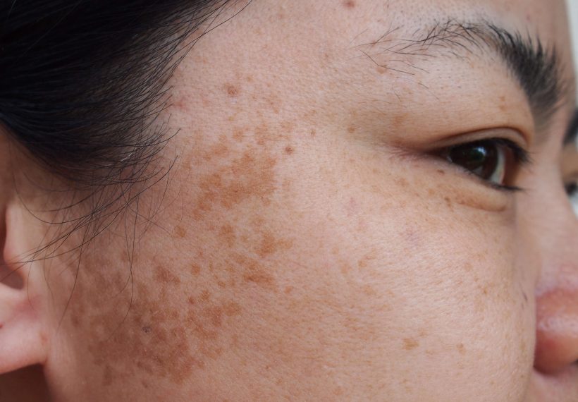 tache pigmentaire sur les tempes femme