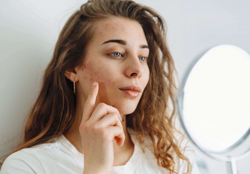 jeune fille avec imperfections et boutons sur la peau et les joues