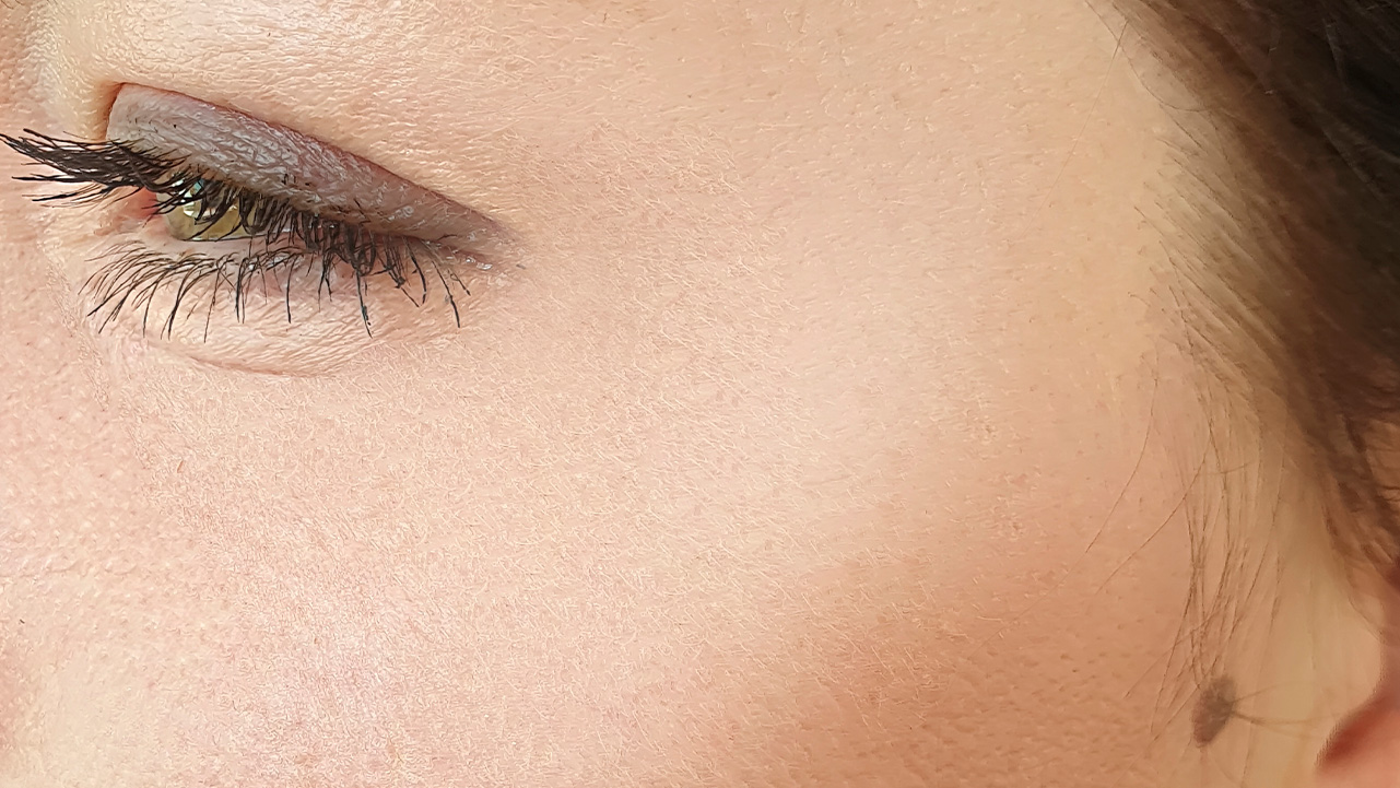 après une séance laser erbium au niveau des yeux