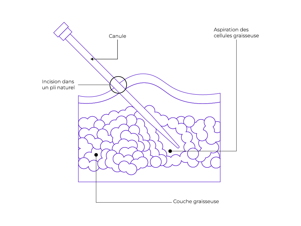 schéma simplifié de la liposuccion