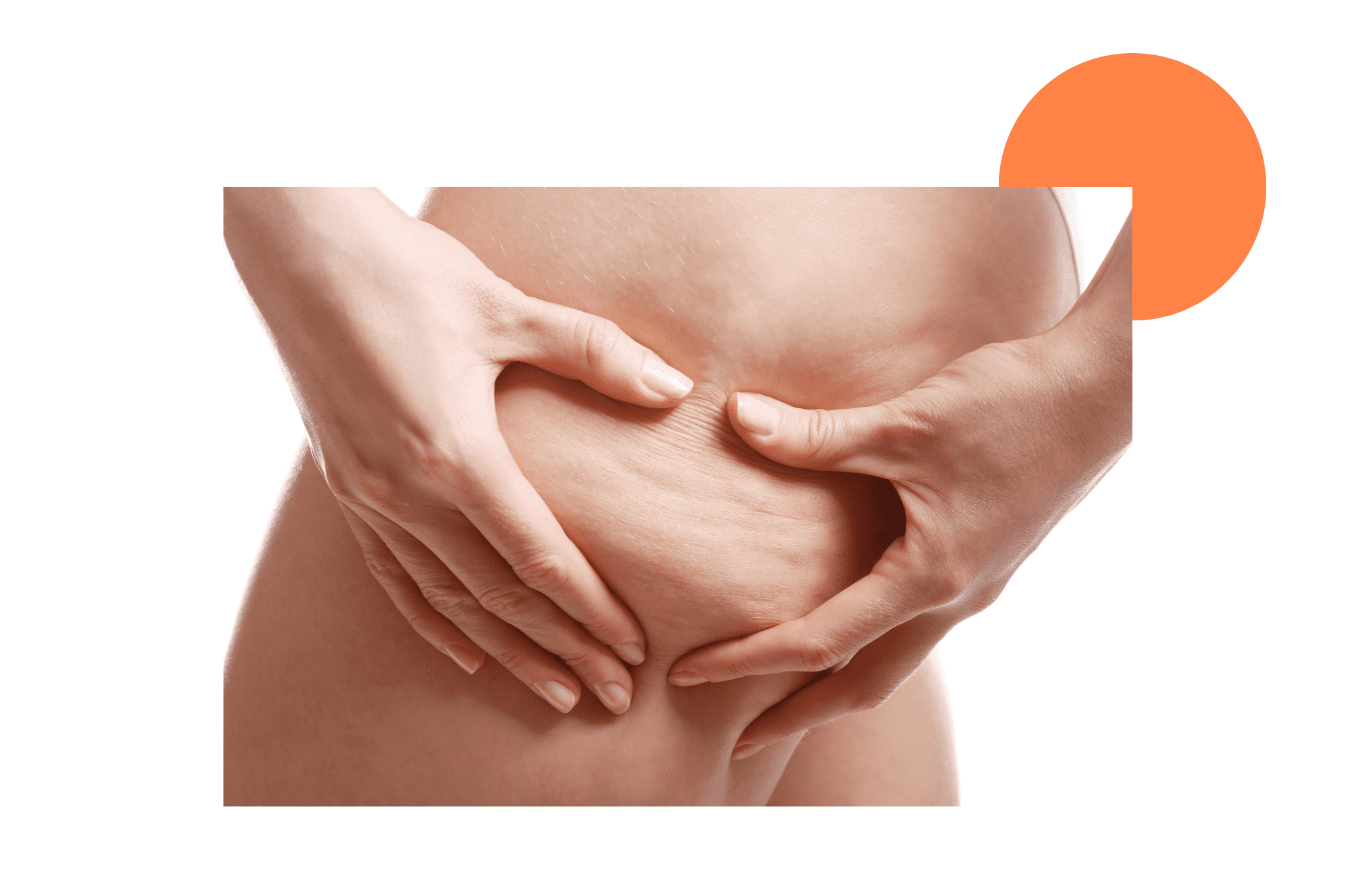 Cellulite aqueuse sur les cuisses d'une femme