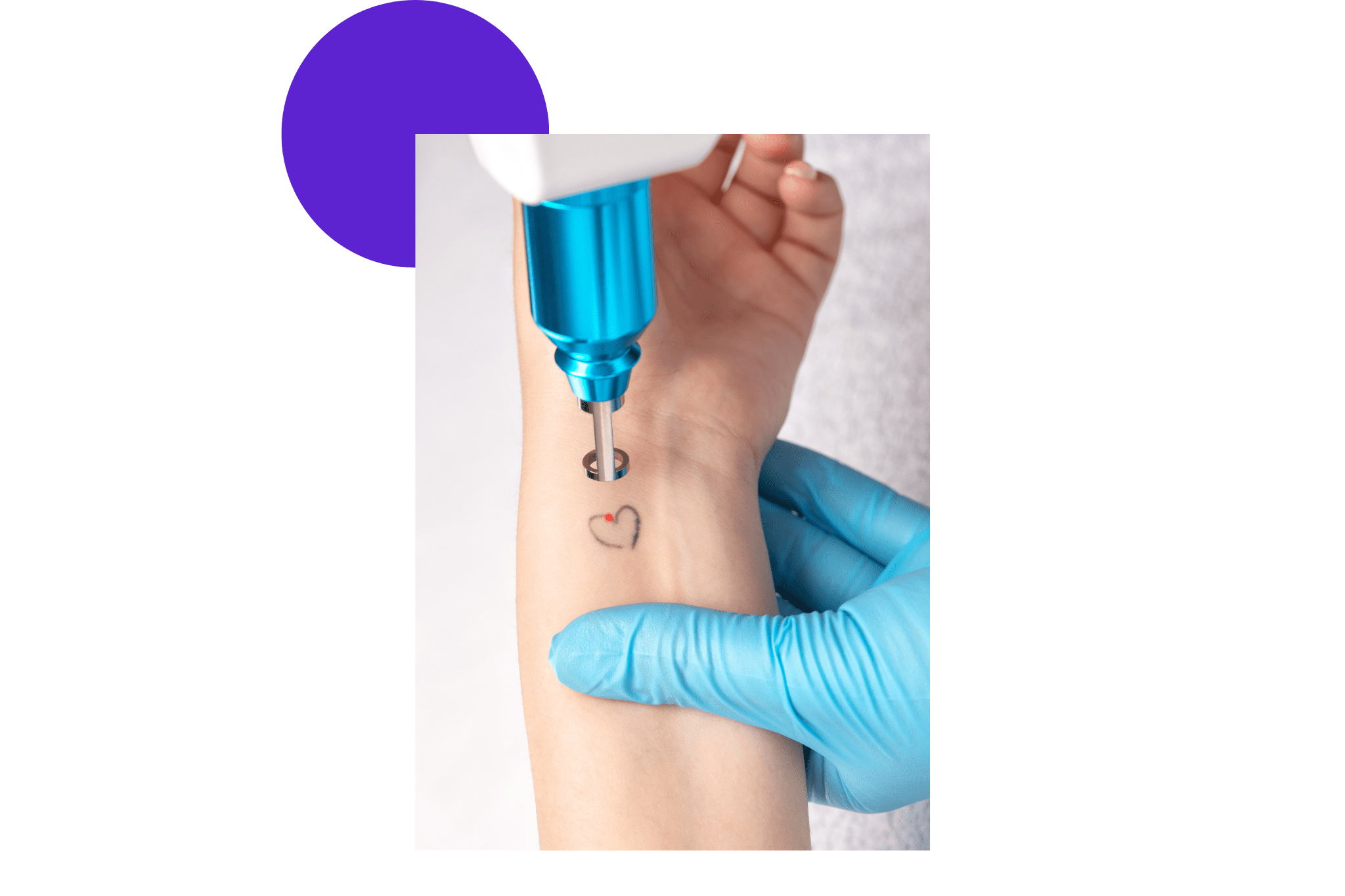 Détatouage sur l'avant bras d'un coeur