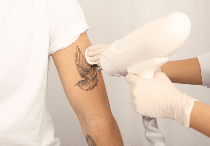 Détatouage sur un bras d'un oiseau
