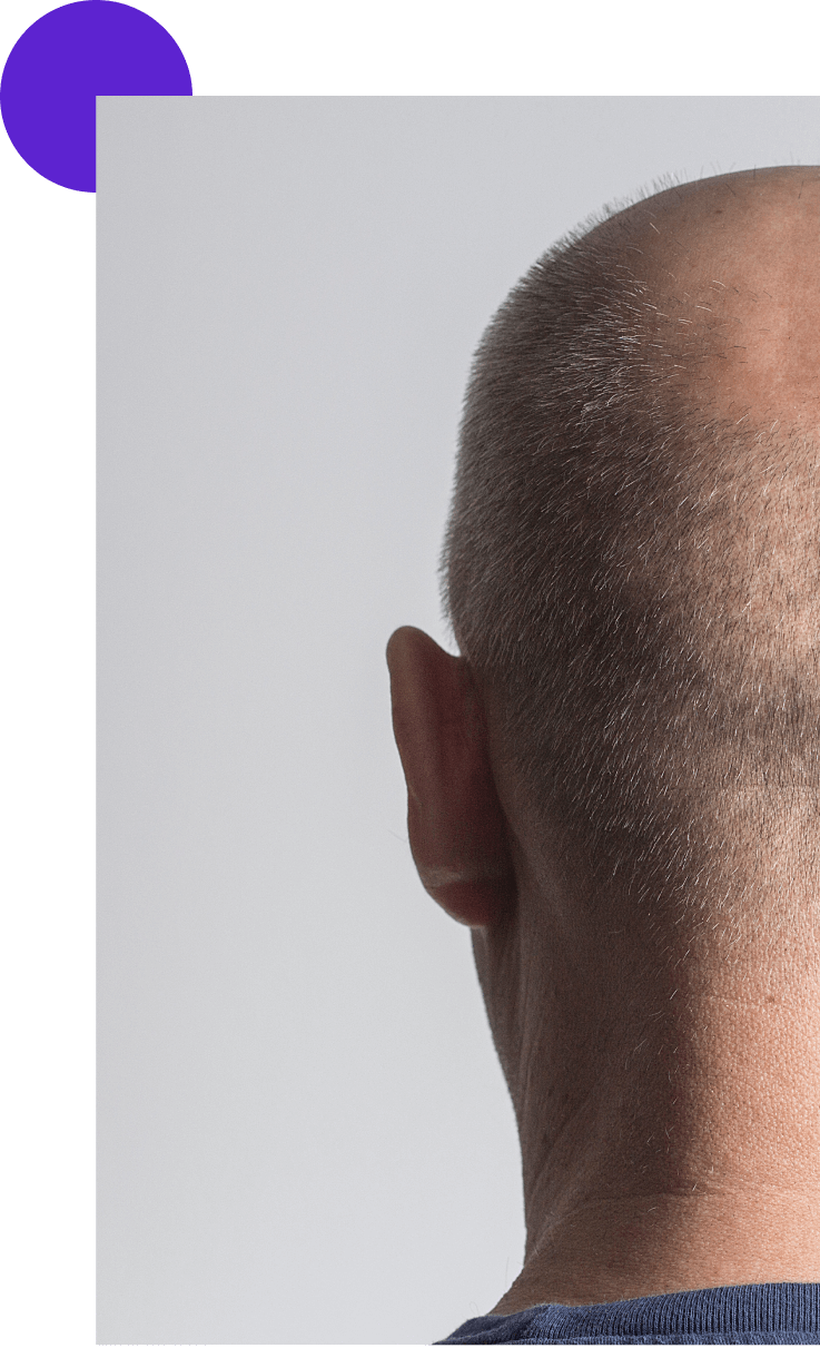 alopécie homme de dos