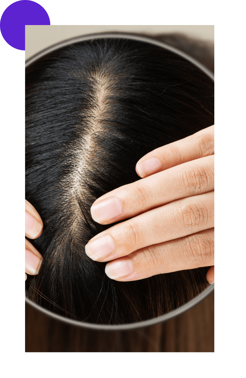 alopécie sur le cuir chevelu d'une femme vue de dessus