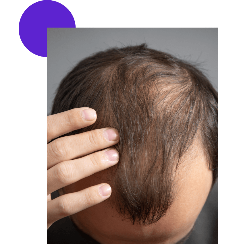 greffe capillaire IFA