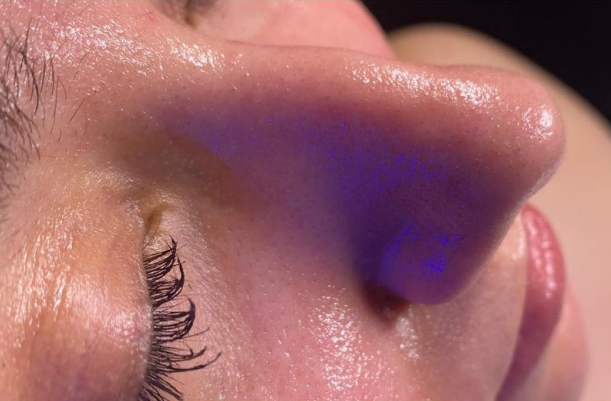 résultats après le soin hydrafacial