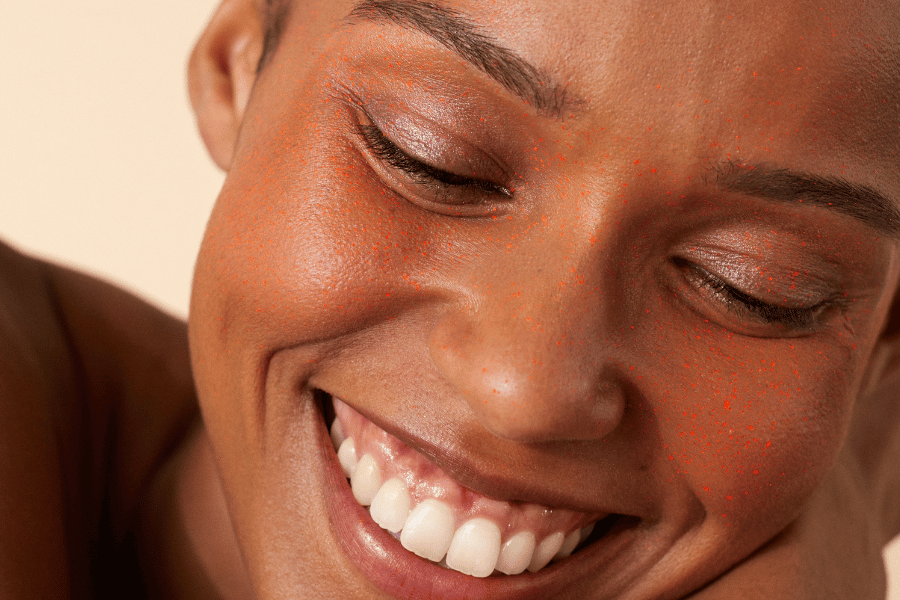 femme avec acné laser aviclear