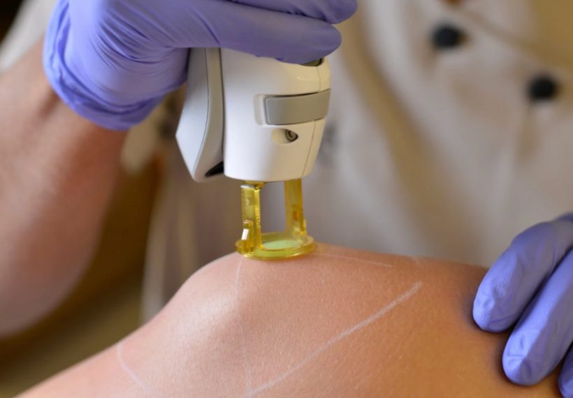 épilation laser sur un genou chez aesthé