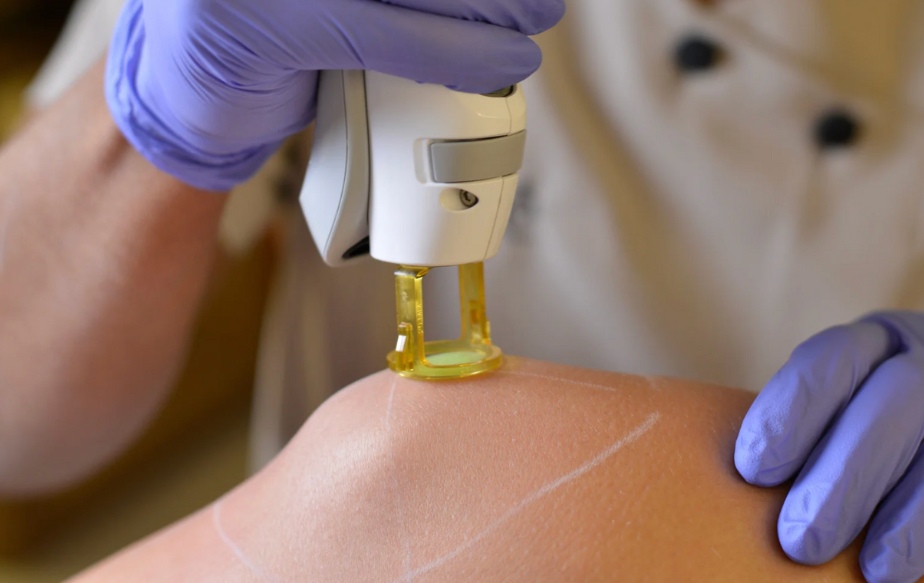 épilation laser sur un genou chez aesthé