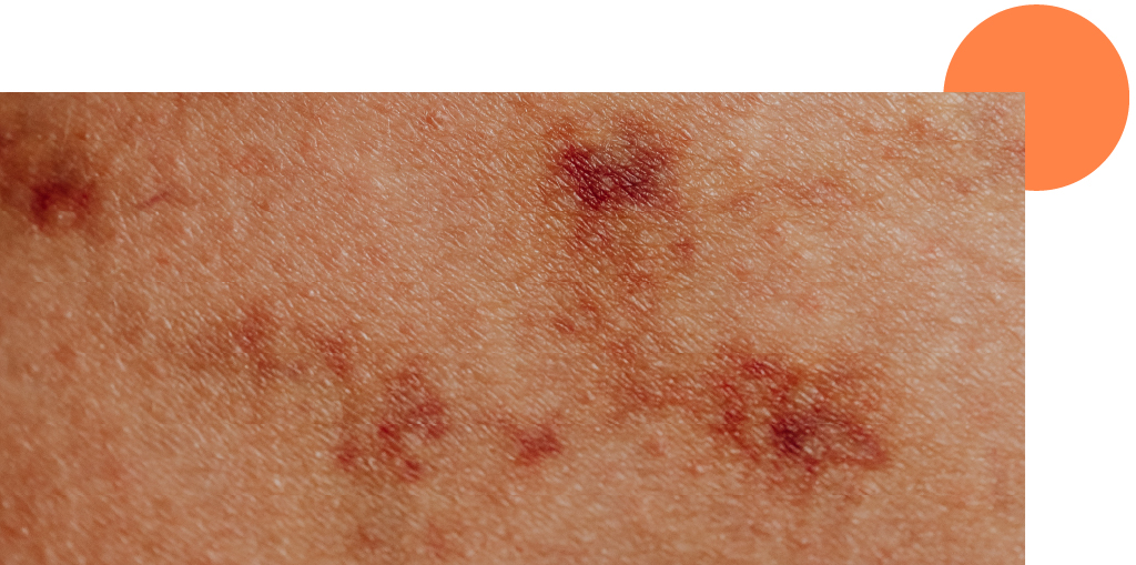 rosacée sur le corps