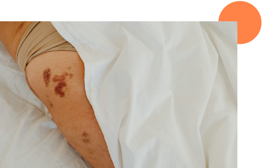 plaques rouges sur le corps 