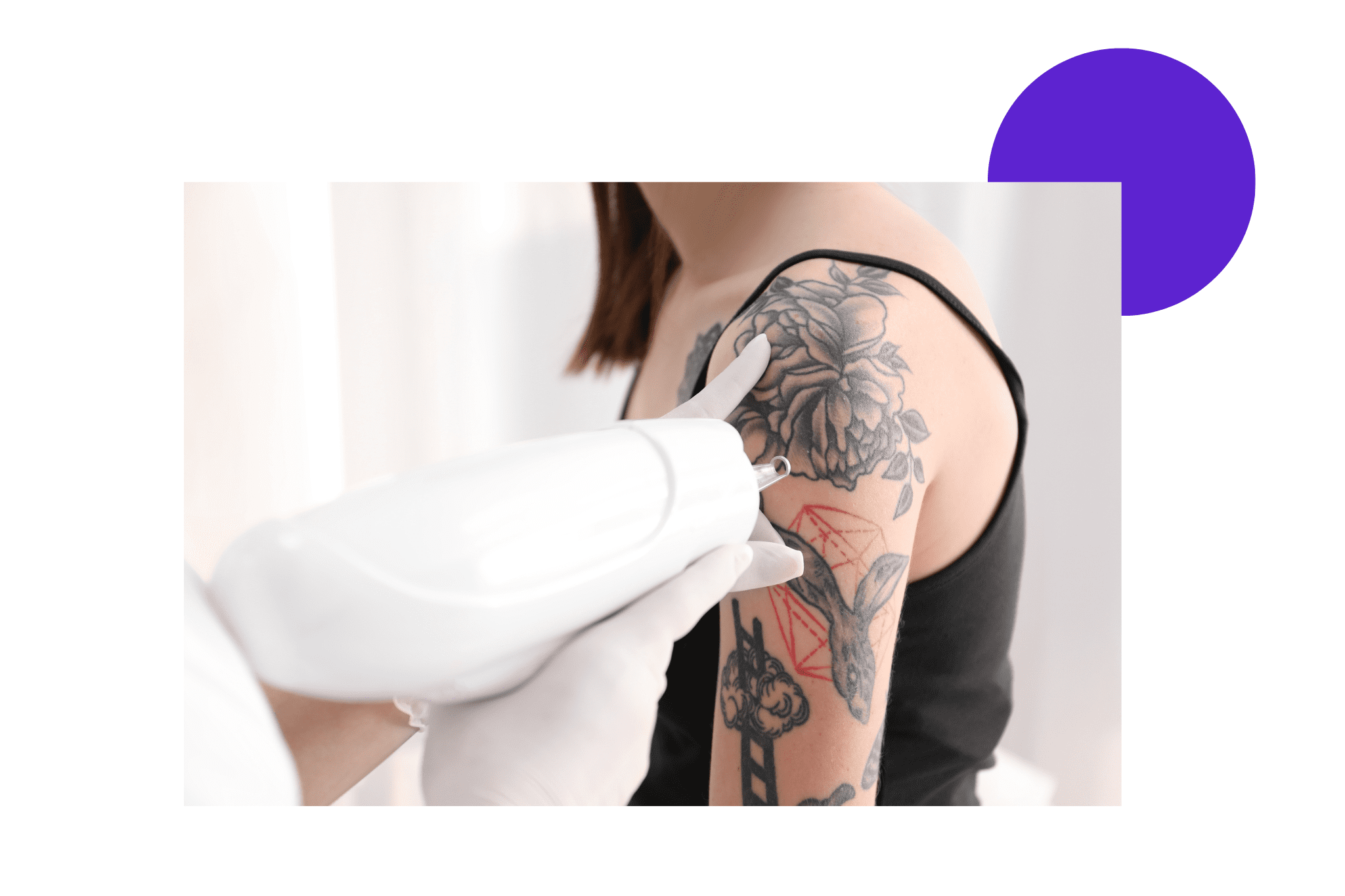 Séance de détatouage sur l'épaule d'une femme