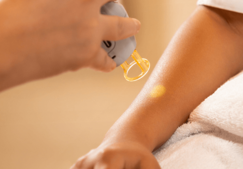 Séance d'épilation laser sur un bras