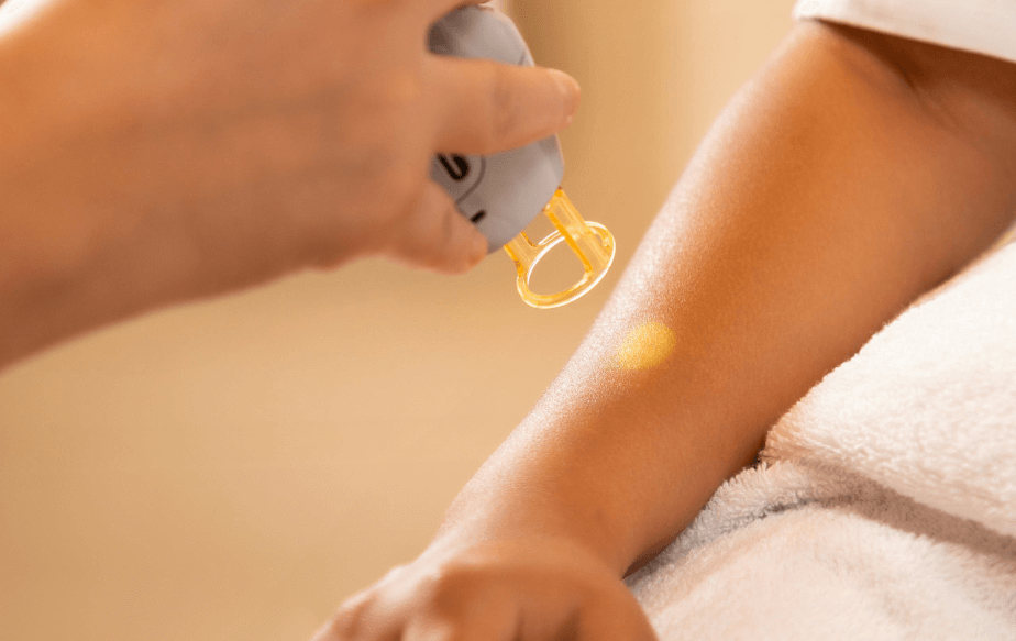 Séance d'épilation laser sur un bras