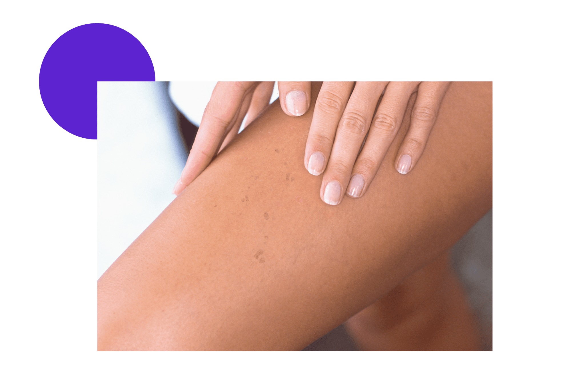 Tache pigmentaire sur les cuisses d'une femme