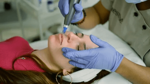 le microneedling sur une de nos patientes