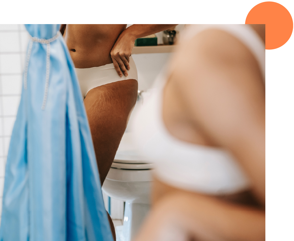 situation vergetures sur les cuisses