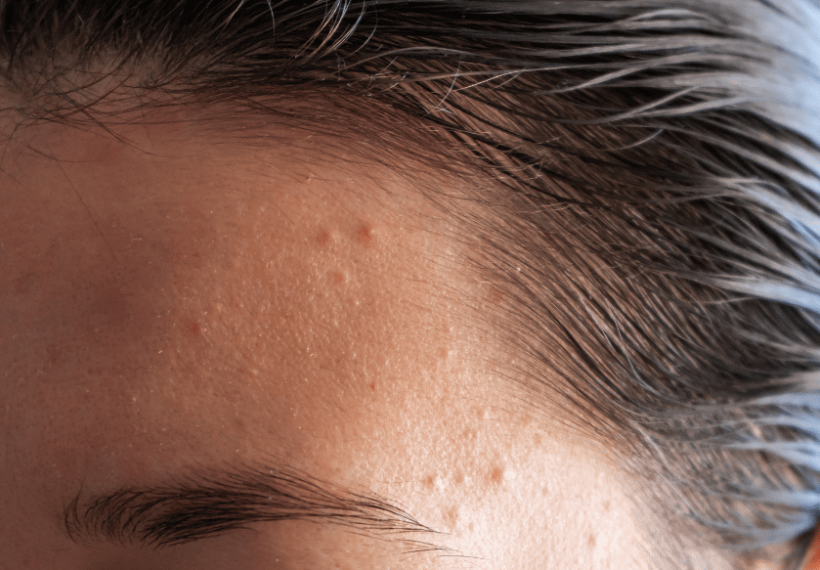 Une personne avec de l'acné hormonale sur le front