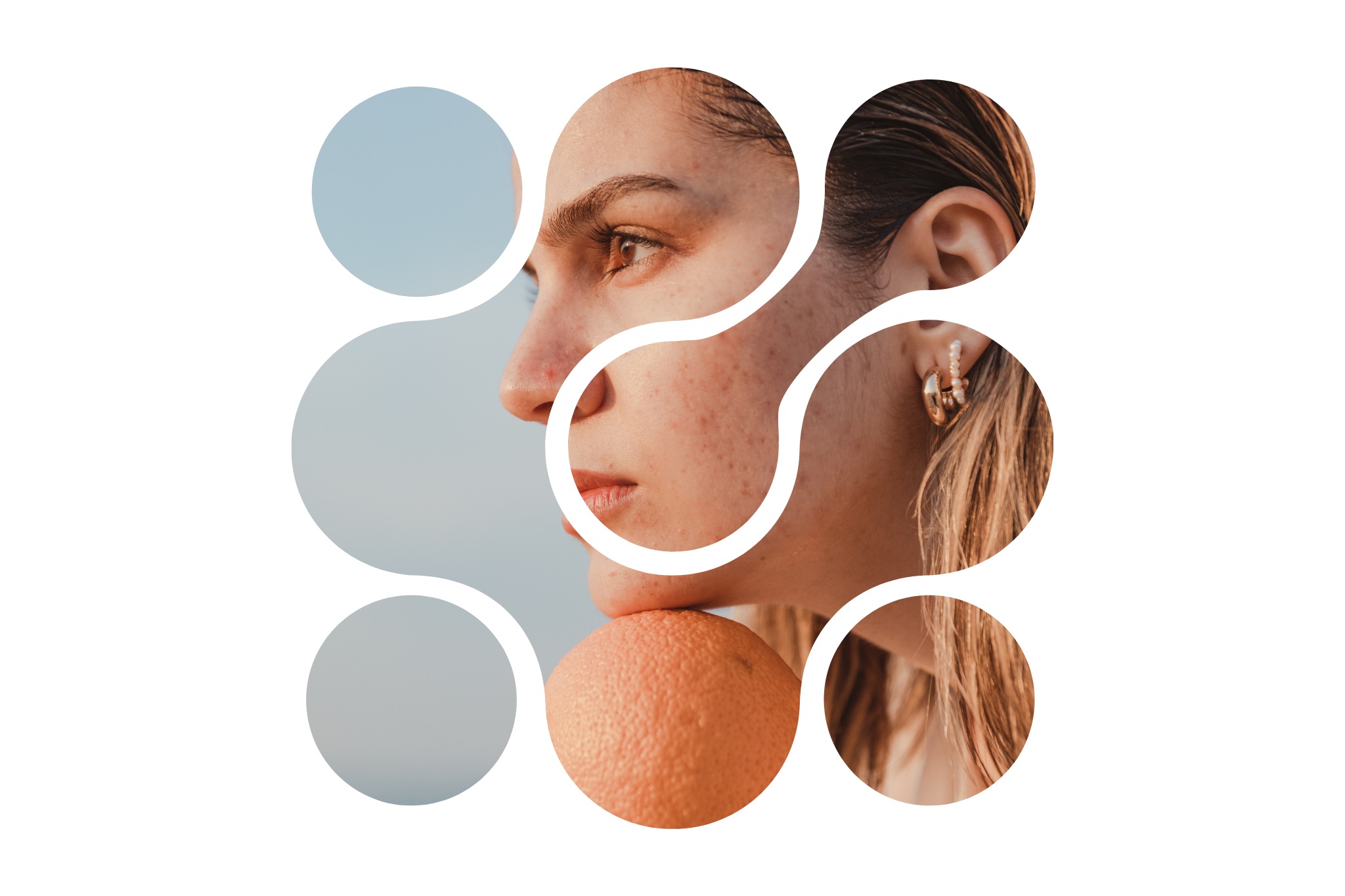 une femme qui a plus de boutons d'acné à cause du soleil