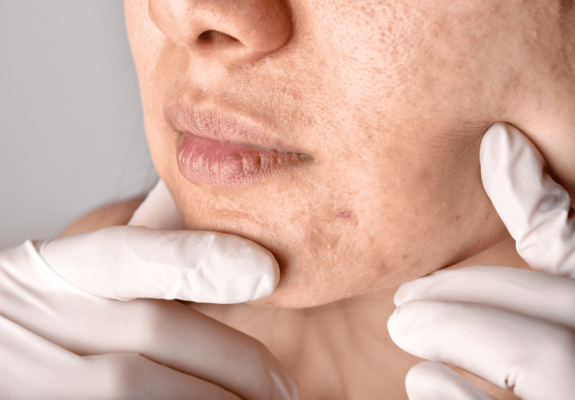 une femme qui a de l'acné à cause du stress
