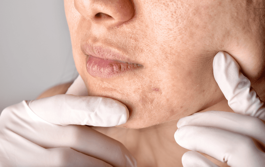 une femme qui a de l'acné à cause du stress