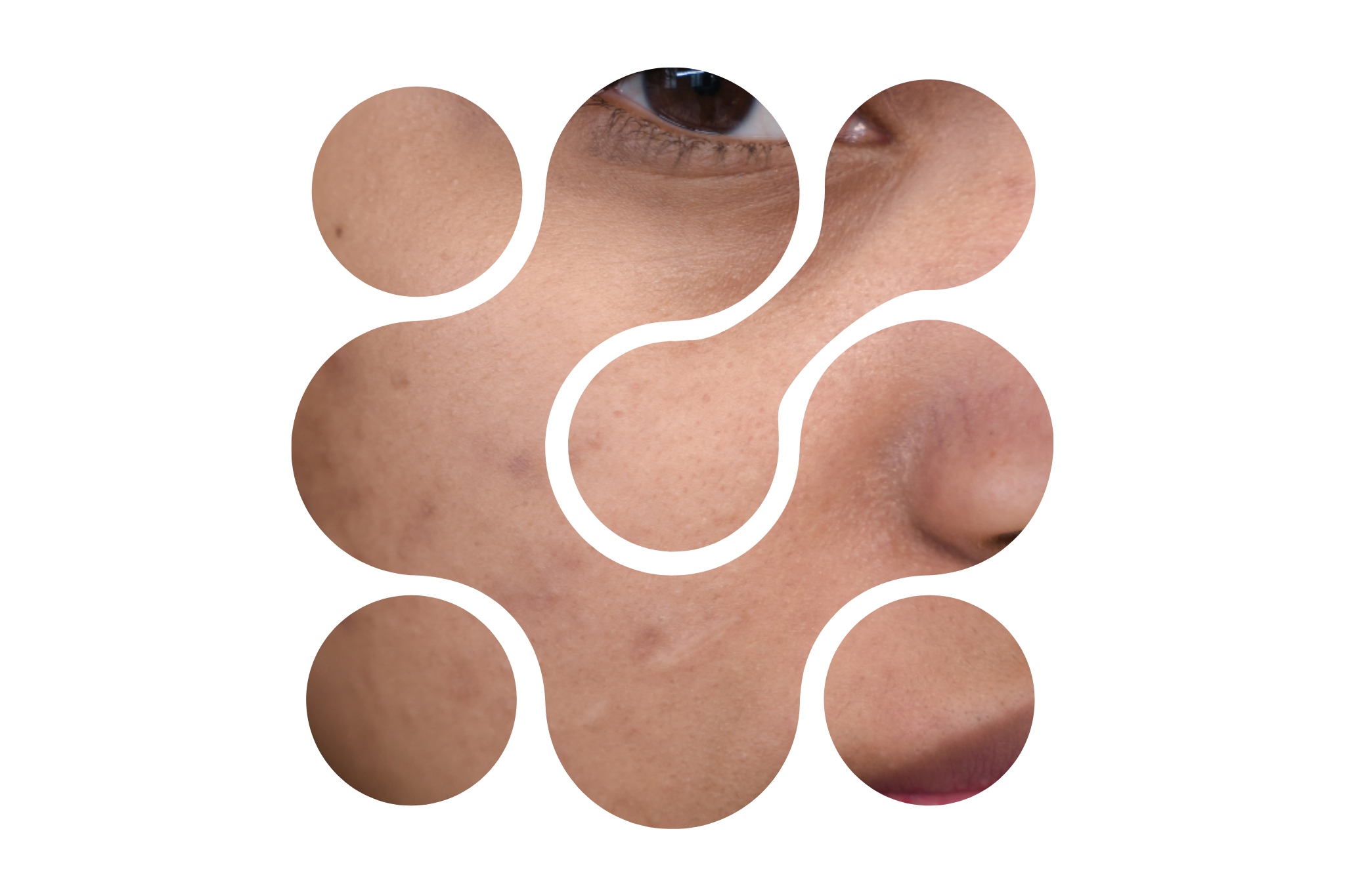 acné sur une femme asiatique