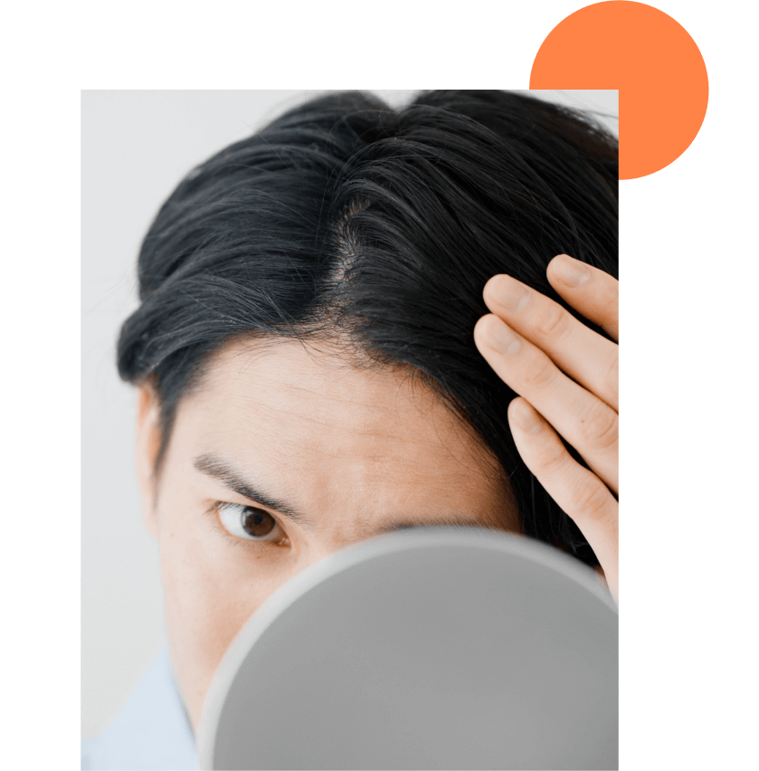 Alopécie androgénique