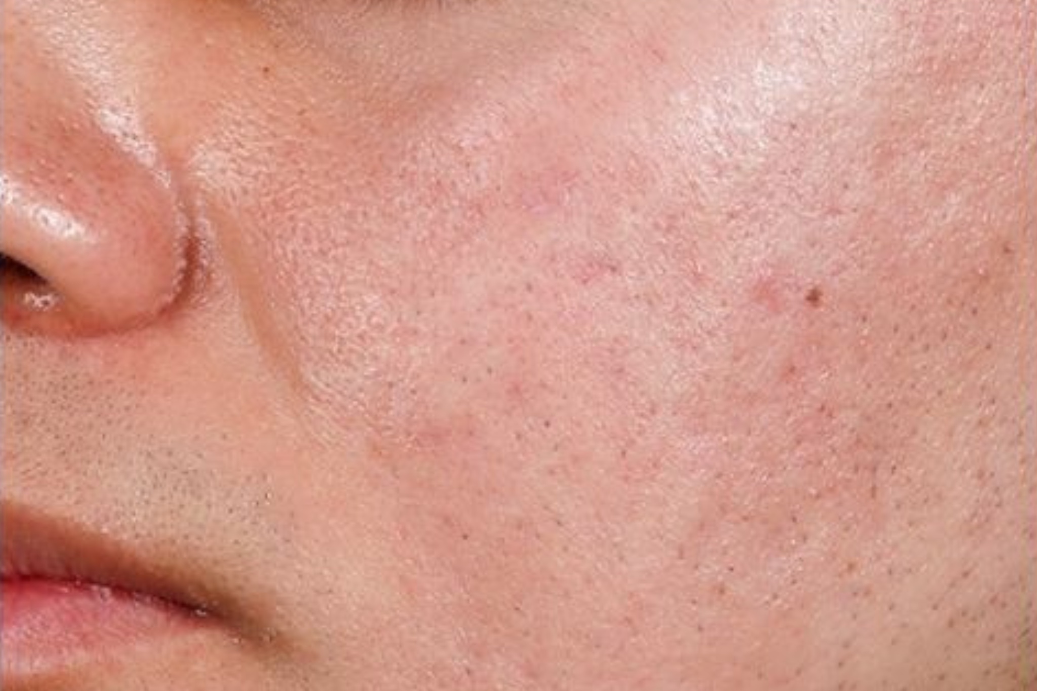 zoom sur joue post traitement aviclear