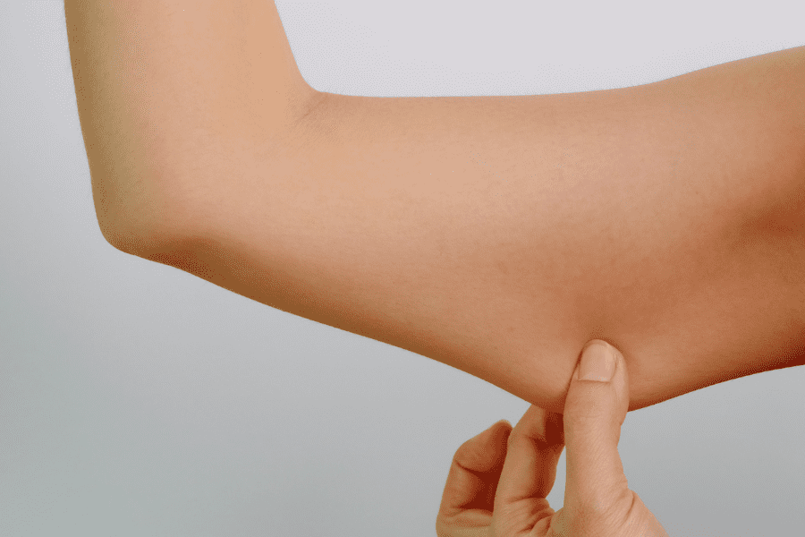 une femme qui a la peau des bras qui pend à cause de la cellulite