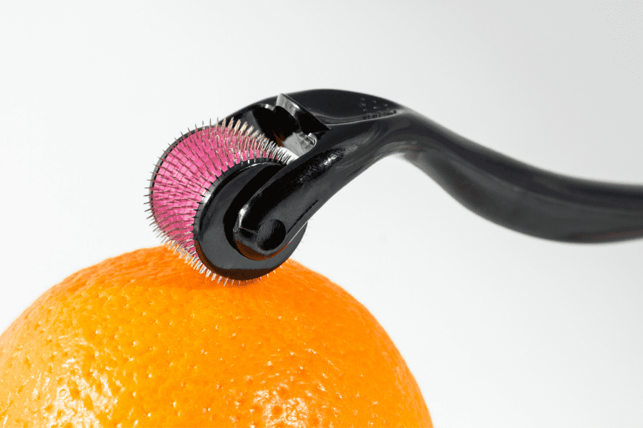 Démonstration de l'utilisation d'un dermaroller qui permet de favoriser la repousse des cheveux