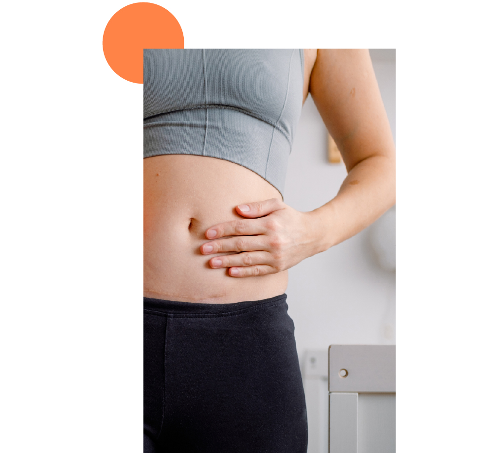 ventre femme avec cicatrices de césarienne