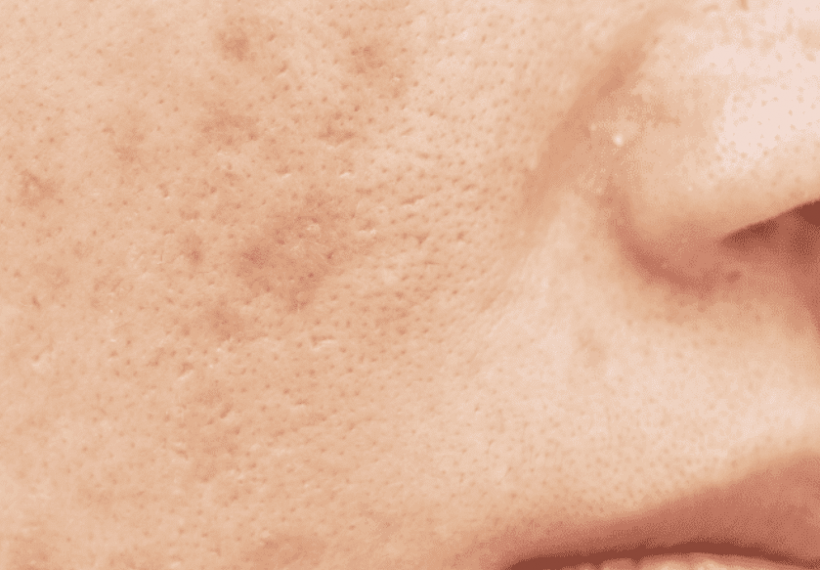 joues avec taches brunes causées par l'acné