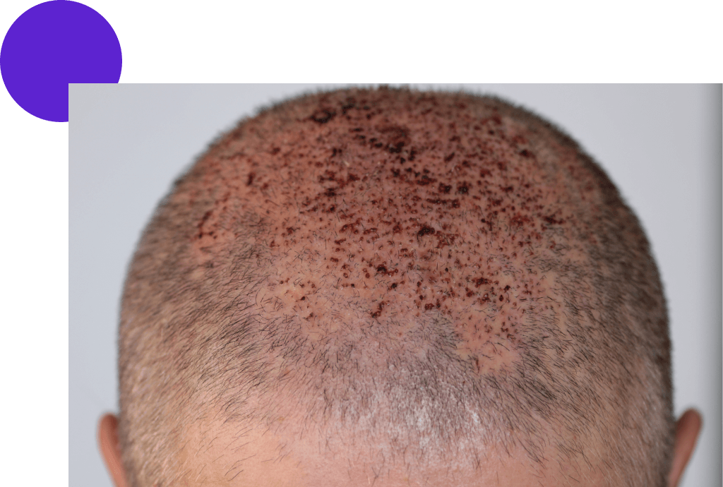 croutes formées sur le dessus du crâne d'un homme après une greffe