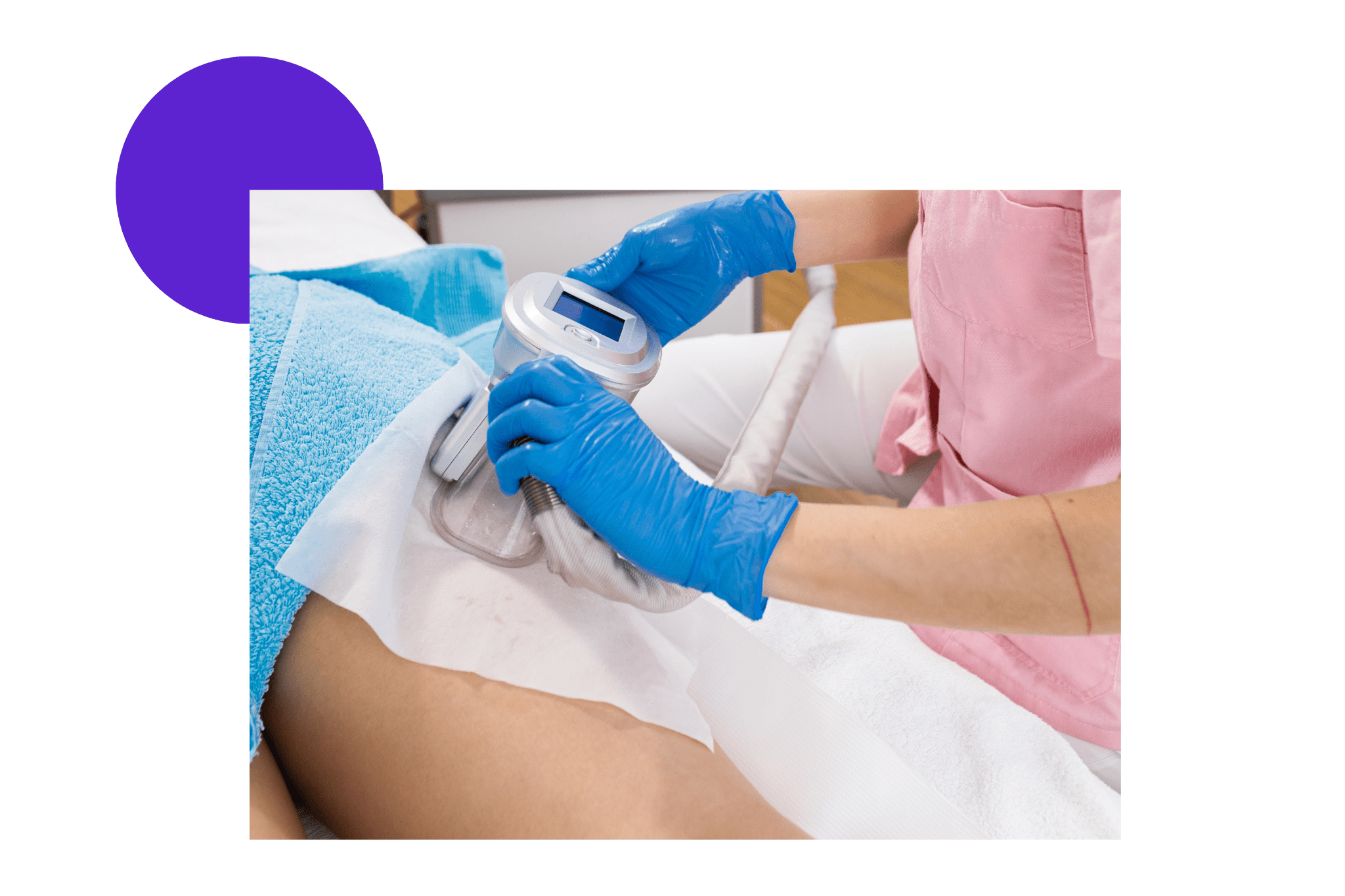 cryolipolyse sur le haut des cuisses