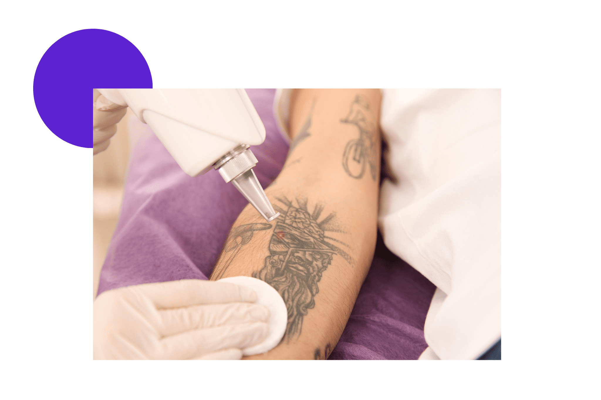 détatouage au laser Pico sur le bras d'une femme