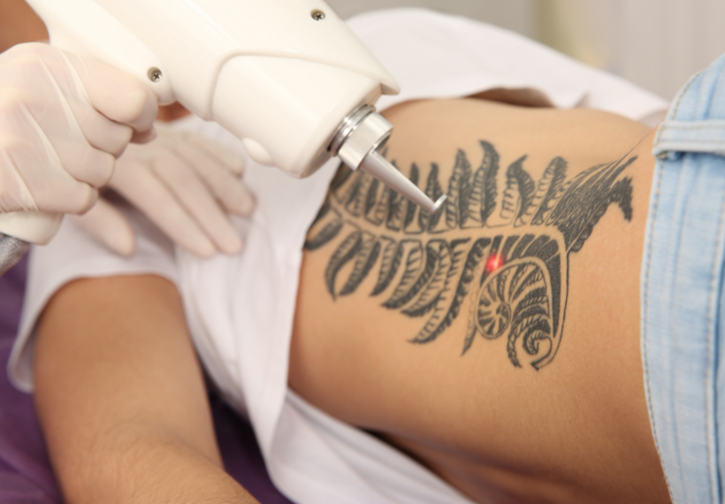 Séance de détatouage d'un tatouage sur le ventre