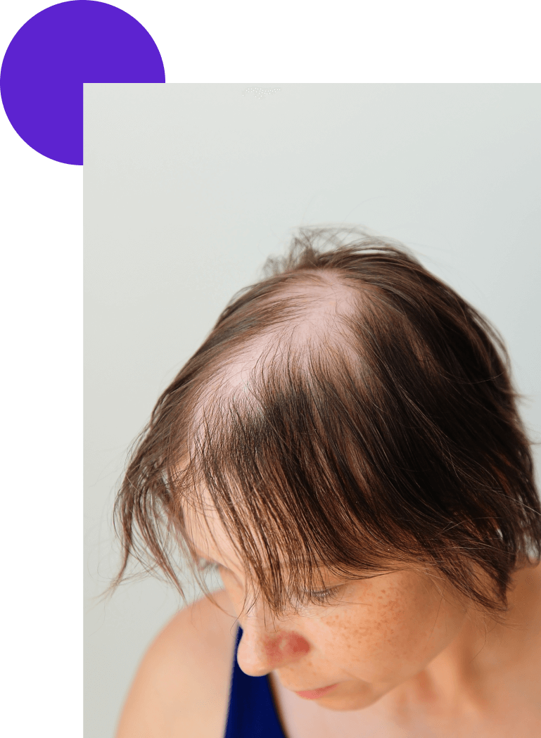 calvitie diffuse sur le crane d'une dame