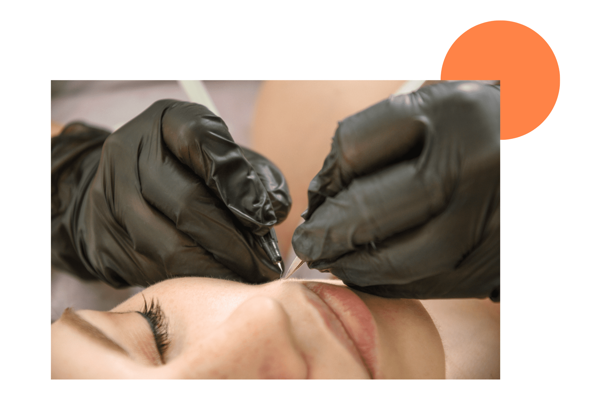 épilation électrolyse du menton d'une femme