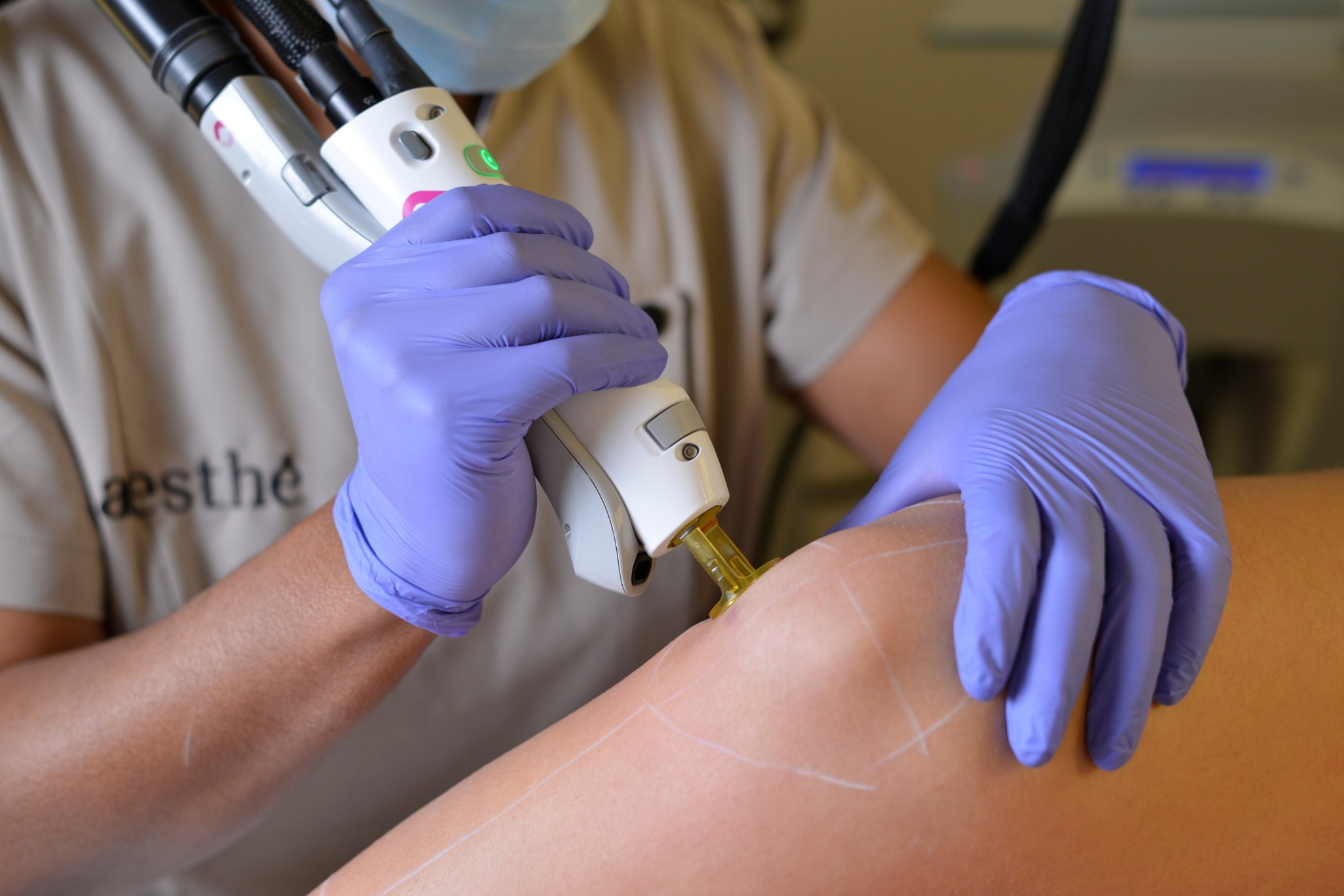 épilation laser du genou avant l'été