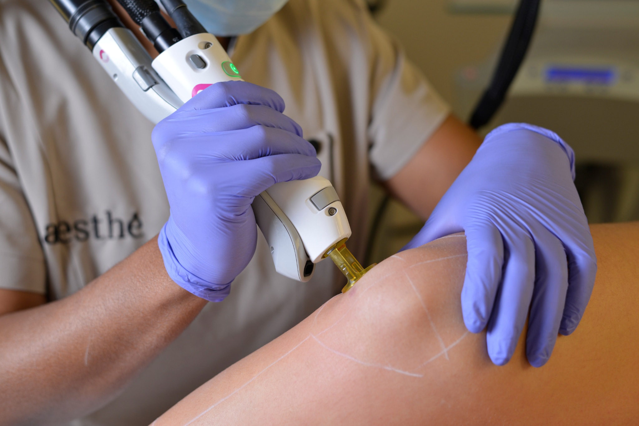 Séance d'épilation laser médicale chez aesthé